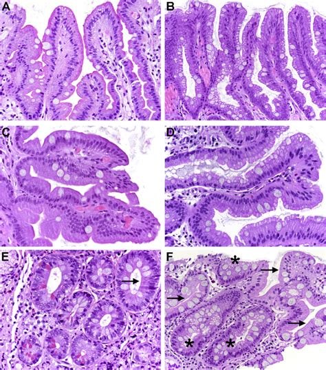 Subtypes Of Gastric Intestinal Metaplasia Gim A Complete Gim Is