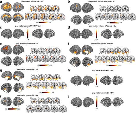 Reduced Gray Matter Volume Reduced Gray Matter Volume Based On A