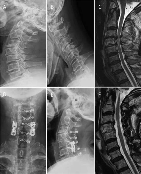 A B Preoperative Dynamic Radiographs Show C5 6 Instability C