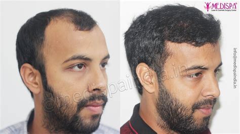 Best Hair Transplant Results Delhi India Hair Transplant Dubai Cost