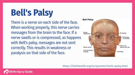 Infant Bell’s Palsy Facial Paralysis