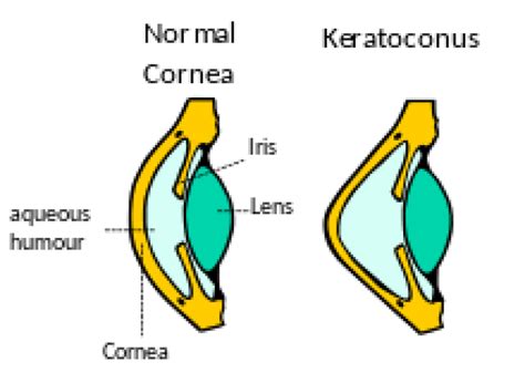 Corneal Cross Linking For Keratoconus Perth Laser Vision