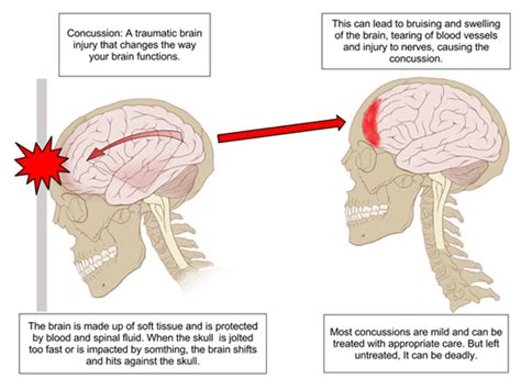 Head Injury Claims Bristol Compensation For Head Injuries