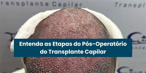 Entenda As Etapas Do P S Operat Rio Do Transplante Capilar Turquia Hair