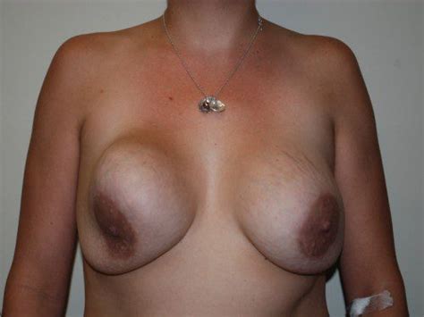 Breast Revision 05 Before After Gallery Allen Doezie MD FACS