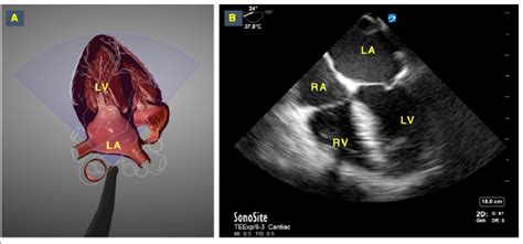 How To Perform Resuscitative Transesophageal Echocardiography In The