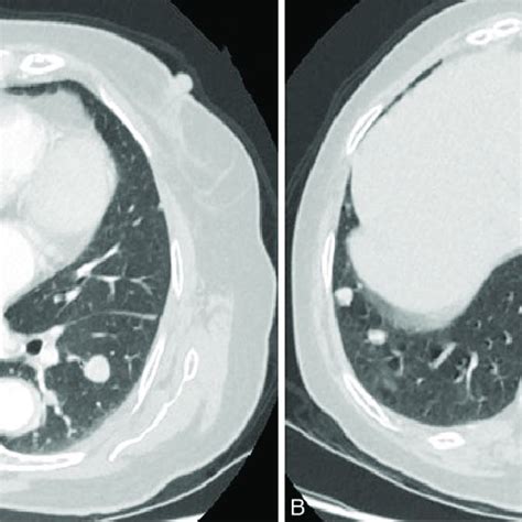 Chest CT scan showed a well-defined nodule in the lower left lung ...