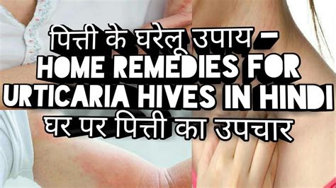 पित्ती के घरेलू उपाय घर पर पित्ती का उपचार Home Remedies For Urticaria Hives In Hindi Youtube