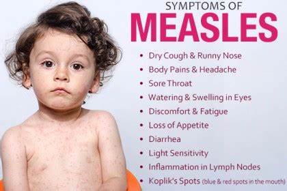 Measles - Midwives Revision