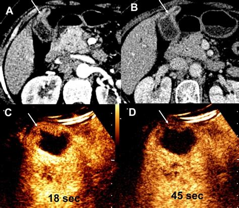 Adenocarcinoma Wall Thickening Type Focal Thickening Of Gallbladder