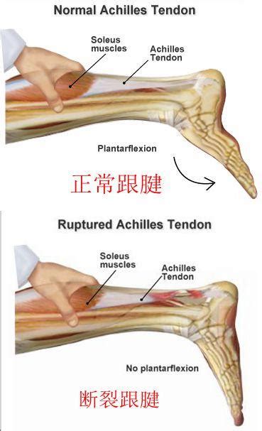 你知道嗎？你的跟腱可能和麥迪的一樣長哦 每日頭條