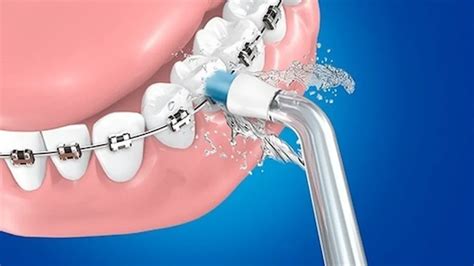 C Mo Usar Irrigador Dental Con Brackets En Pasos Pro