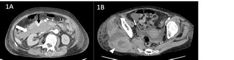 Contrasted Computed Tomogram CT Of The Abdomen And Pelvis In The