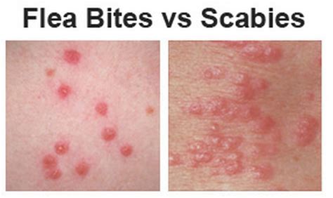 Scabies Rash Distribution