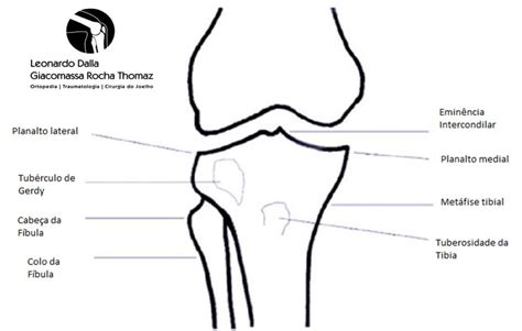 Tratamento De Fraturas Do Planalto Tibial Dr Leonardo Rocha Thomaz