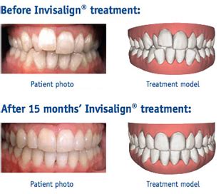 Invisible Braces Glasgow | The Benefits of Invisible Braces