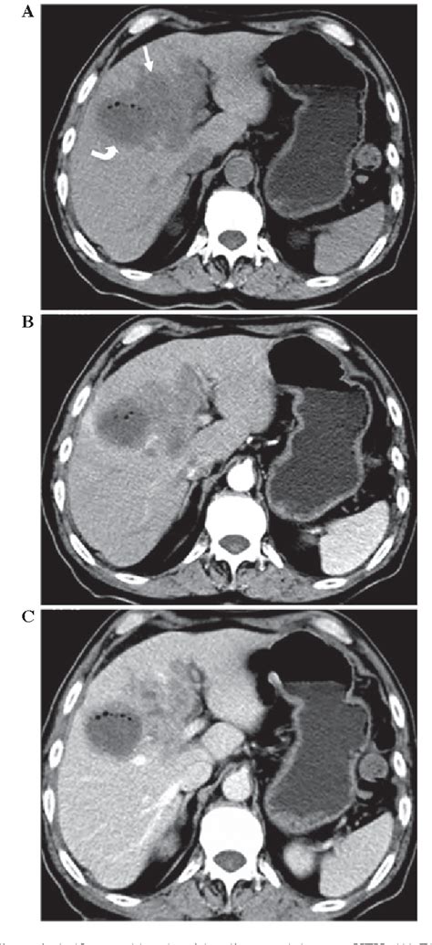 Figure 1 From Typical CT And MRI Signs Of Hepatic Epithelioid