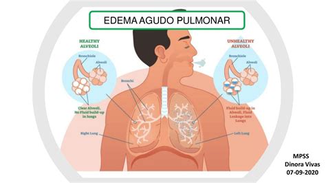 Edema Agudo De Pulm N Dinora Vivas Udocz