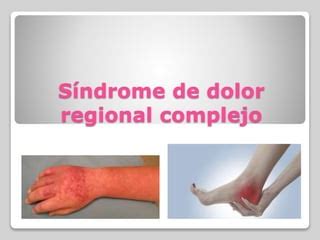 S Ndrome De Dolor Regional Complejo Ppt