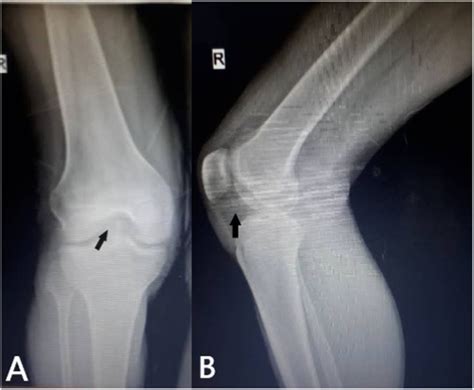 Anteroposterior A And Lateral B X Rays Reveal A Shadow Into The Download Scientific