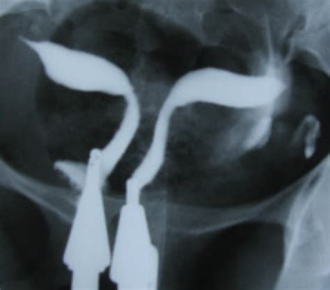 Uterine Septum Hsg