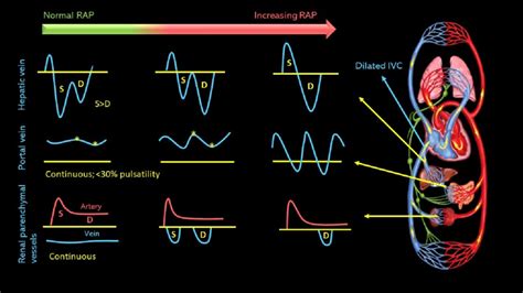 Illustration Showing The Natural History Of Venous Doppler Waveforms