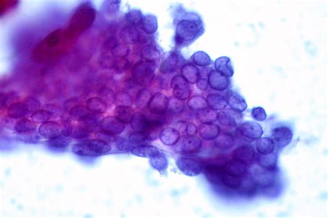 Papillary Thyroid Carcinoma Fna Rapid Pap Stain Ed Uthman Flickr