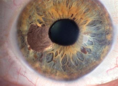 Ocular Melanoma Pictures – 27 Photos & Images / illnessee.com