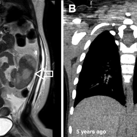 Ultrasound Of The Spleen Demonstrates Heterogeneous Internal Download Scientific Diagram