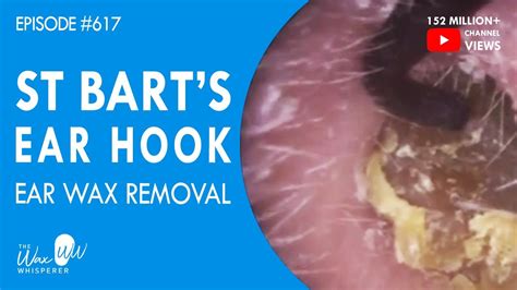 617 St Bartholomews Ear Hook Ear Wax Removal Youtube