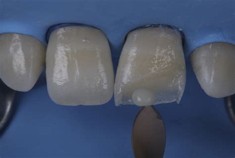 Making Class Iv Restorations Predictable Idental Study