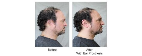 Auricular (Ear) Prosthesis for Osseointegrated Ear Implant | Custom ...