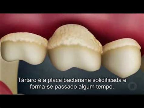 Placa Bacteriana E T Rtaro Youtube