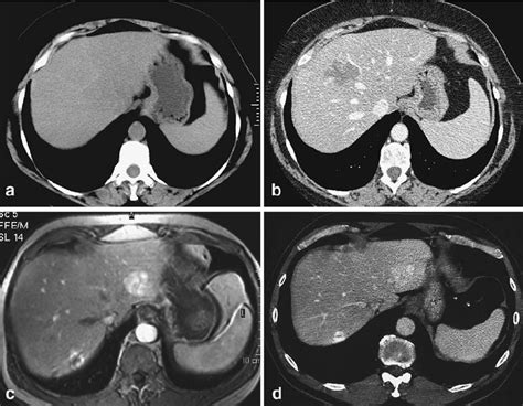 Haemangioma And Associated Liver Abnormalities A B Haemangioma In