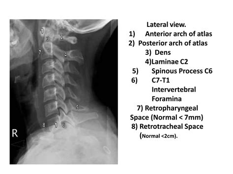 X ray c-spine | PPT