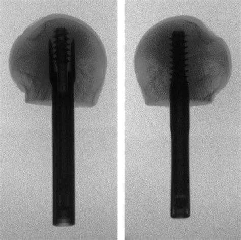 Anteroposterior X Rays Of Centrally Inserted Rosa He Left And