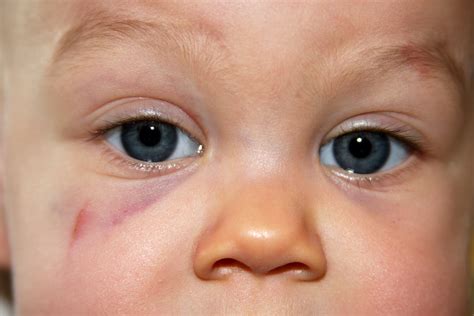 And Baby Makes Four First Black Eye