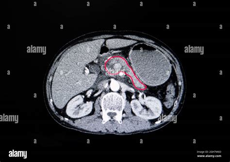 CT Scan Of The Abdomen Of A Patient With Carcinoma Of The Head Of