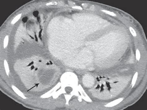 Pulmonary Infection In A Patient With Sle Presenting With Fever Download Scientific Diagram