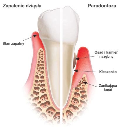 Co każdy powinien wiedzieć o leczeniu przyzębia Dentim Clinic