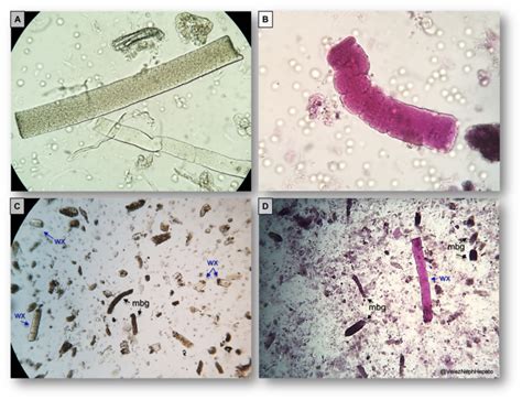 Urine Sediment Of The Month Waxy Casts Renal Fellow Network