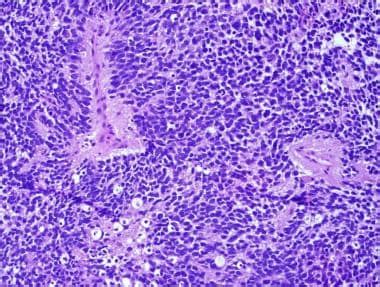 Pathology Of Embryonal Tumors Overview Pathophysiology And Etiology