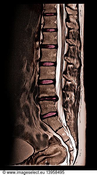 Herniated Disc Herniated Disc, MRI,ddd,degenerative,disease - Rights ...