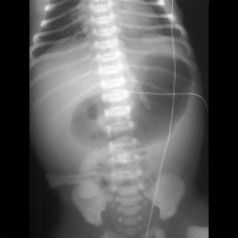 Double Bubble Duodenal Atresia