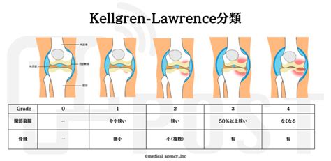 変形性膝関節症の分類とリハビリテーションプロトコール 理学療法士・作業療法士・言語聴覚士の求人、セミナー情報なら【post】