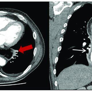 Exemplary CT-scan of an incarcerated hiatal hernia on the left thoracic... | Download Scientific ...