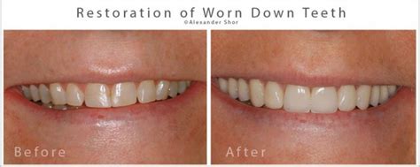 Tooth Wear Treatment Seattle - Shor Dental