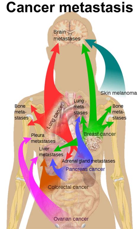 Cancer metastasis causes, symptoms and metastasis survival rate