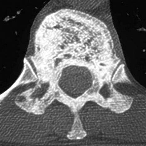 Imaging Of Paget Disease Of Bone And Its Musculoskeletal Complications