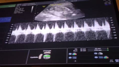 Baby Boy S Heartbeat At 16 Weeks YouTube